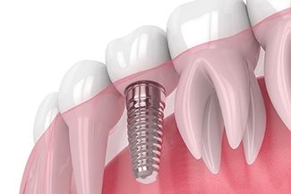 Dental implant in Viera