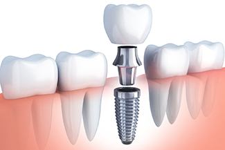 Diagram of a single tooth dental implant