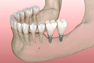 Diagram showing mini dental implants