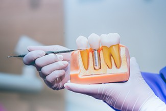 Dentist pointing to dental implant model