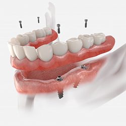 a 3 D illustration of All on 4 implants