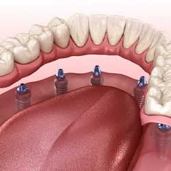 Diagram of implant dentures in Viera