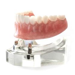 implant-retained denture