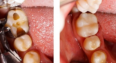 A before and after of a tooth receiving a filling.