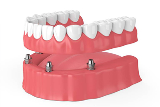 Implant-retained denture