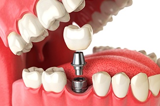 Diagram of how dental implants in Melbourne work