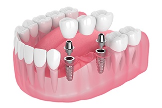 Diagram showing implant bridge replacing multiple missing teeth