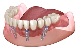 Diagram showing an implant denture