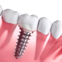 dental implant