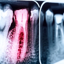 red tooth root canal