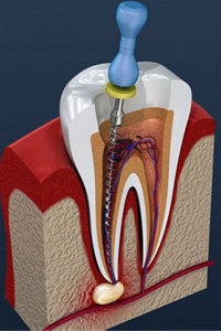 root canal in Viera
