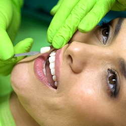 a dentist about to place a veneer on a patient’s tooth