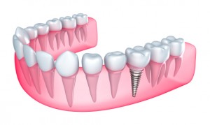 See Dr. Chenet for dental implants in Melbourne. 