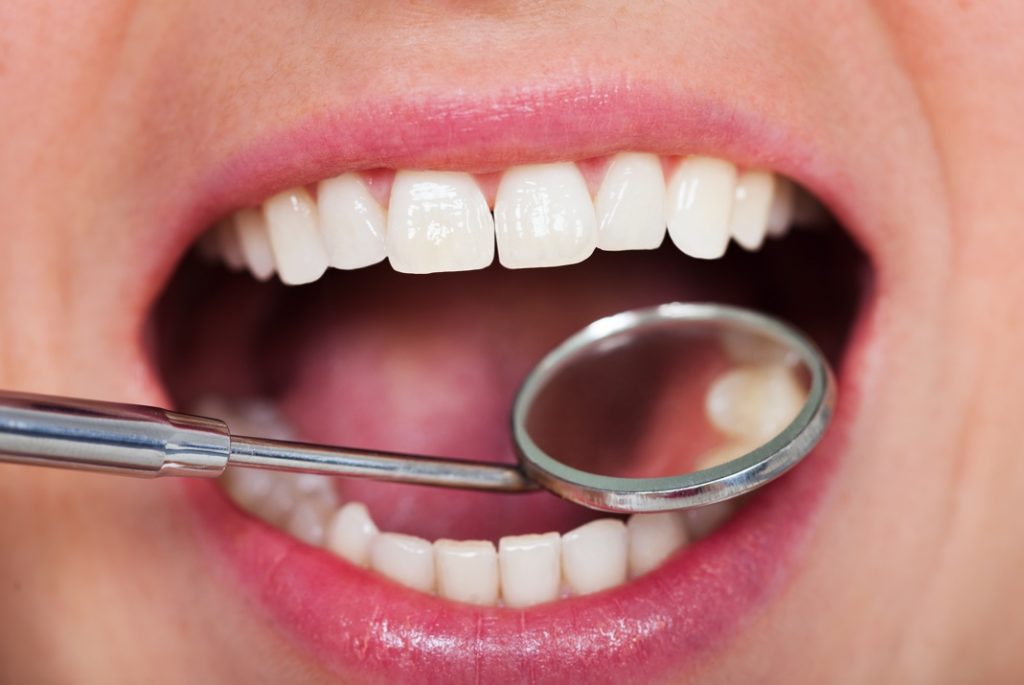 Person with tooth-colored fillings at their dentist in Viera