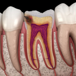 a computer illustration of a cavity between teeth