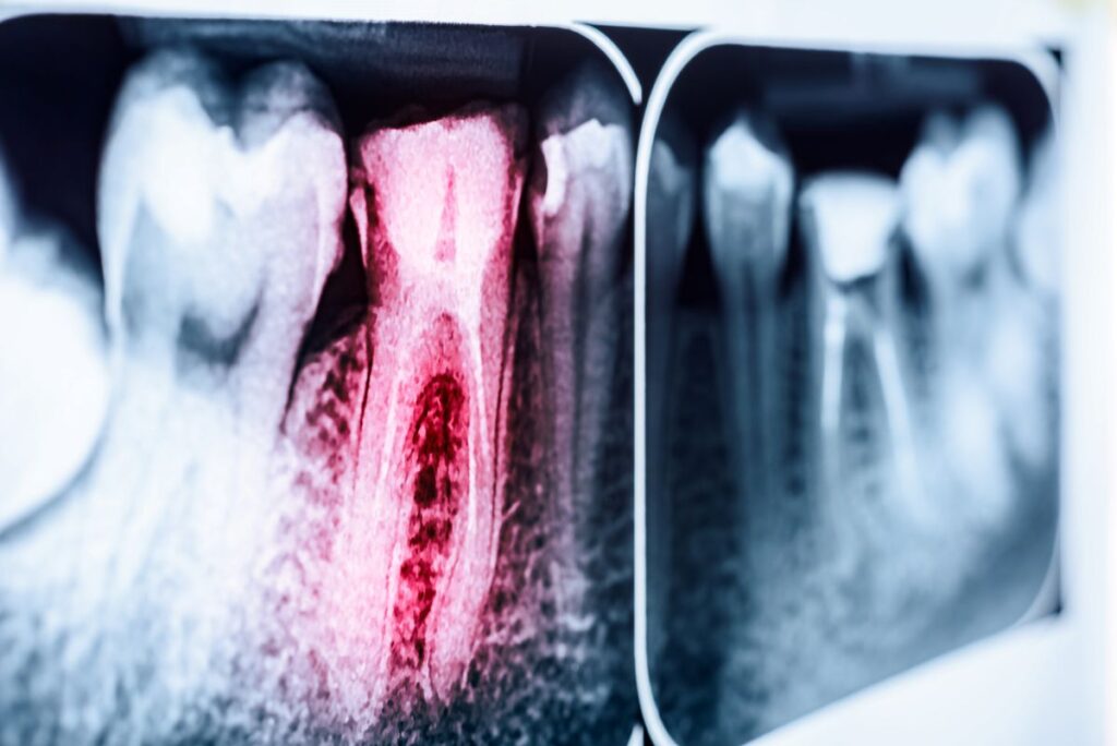 An X-ray of an infected tooth