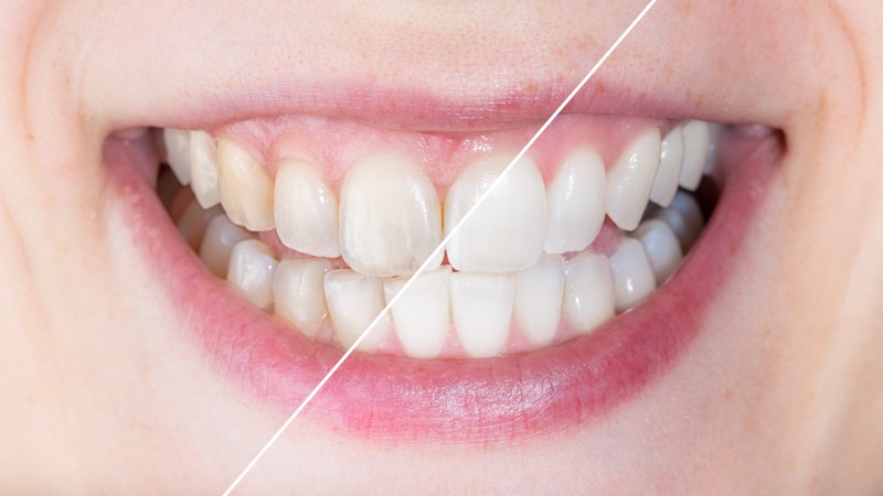 up-close view of stained and whitened teeth