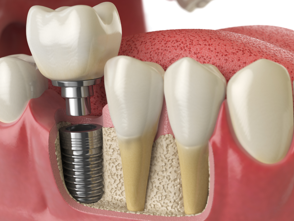 3D image of a dental implant