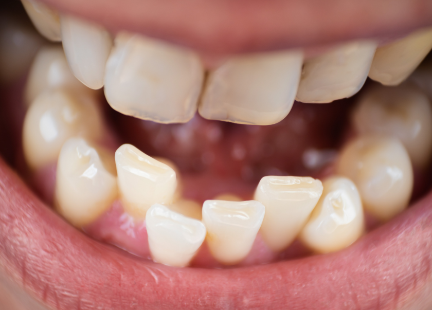 Close up of crooked teeth