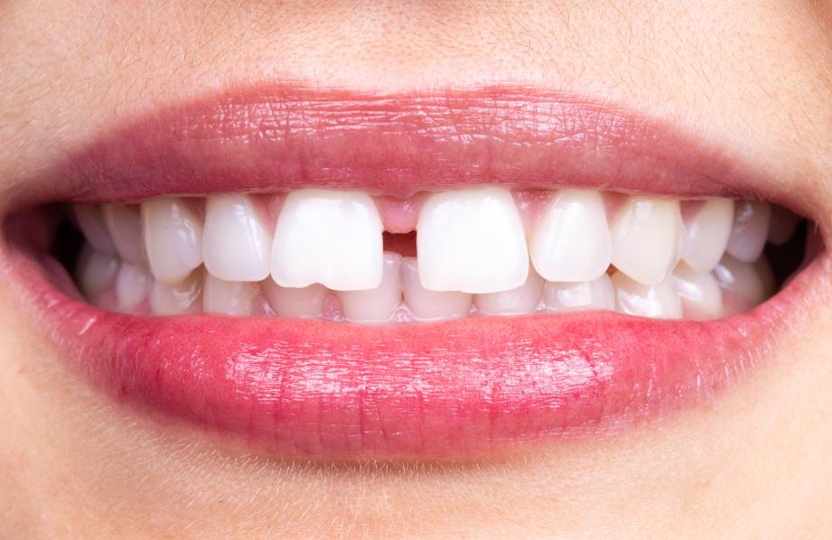 Close up of woman's smile with gap between front teeth