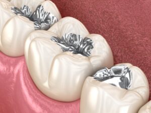Metal tooth fillings.
